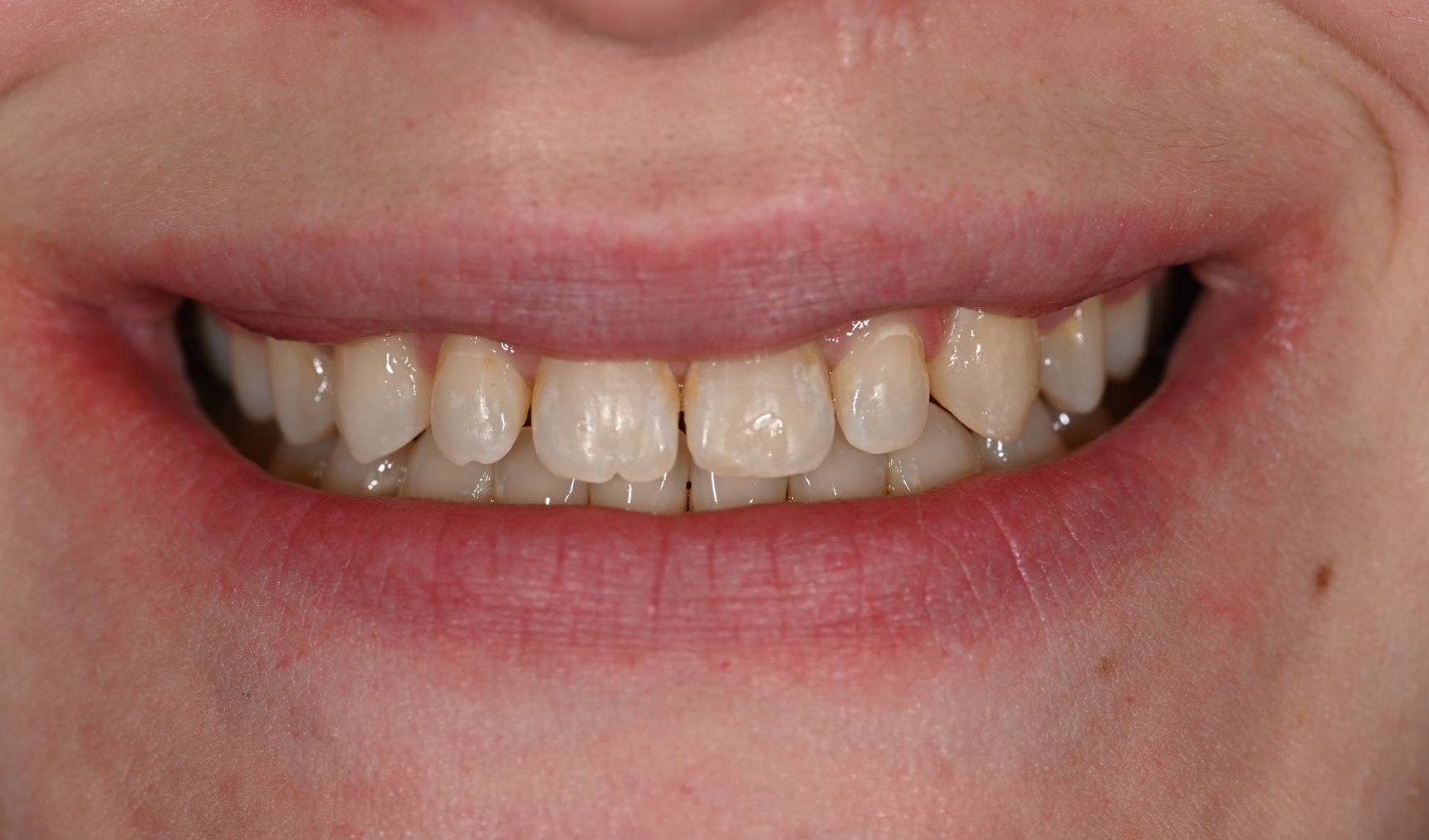 Veneers Before & After Image