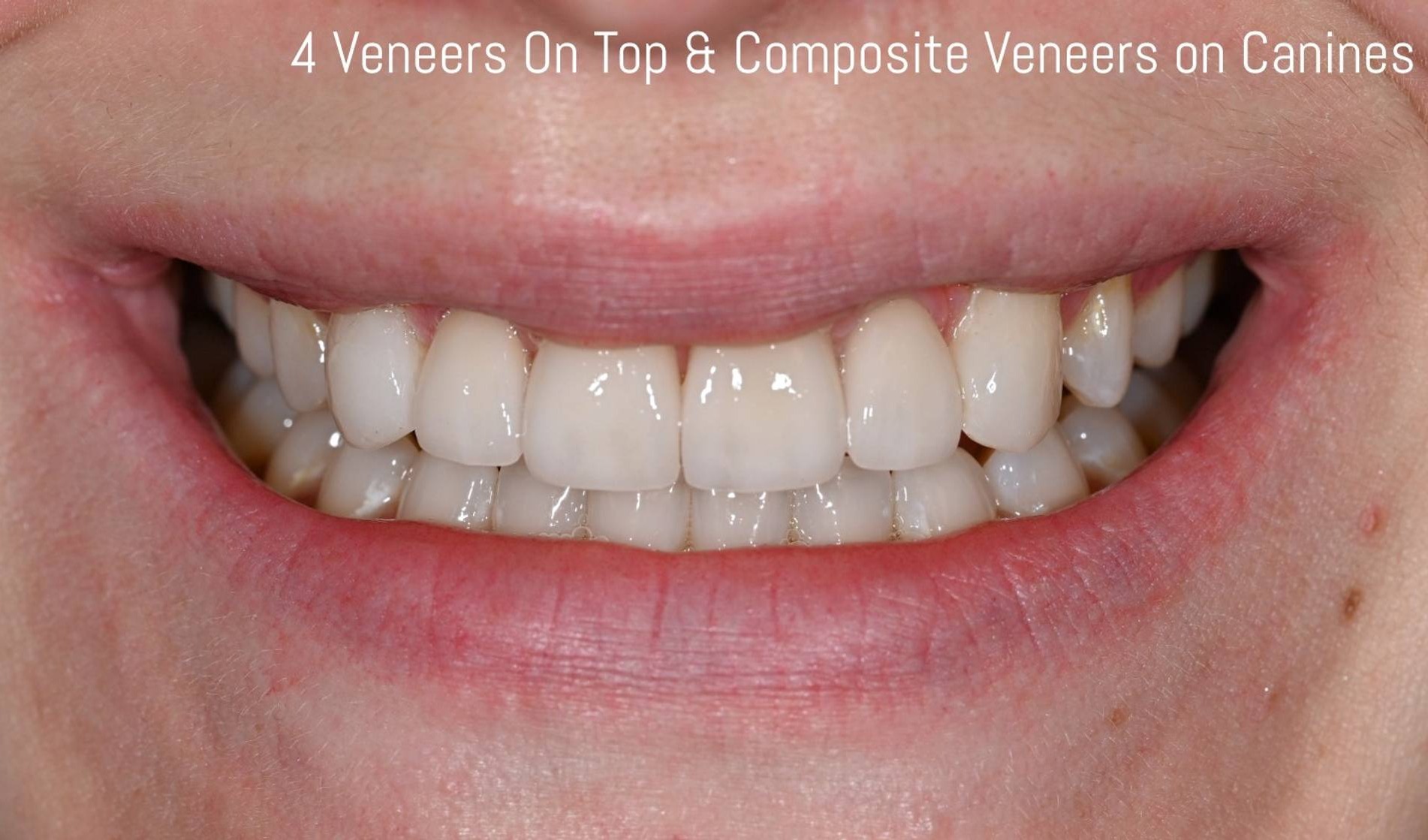 Veneers Before & After Image