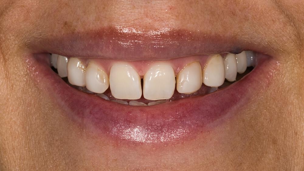 Veneers Before & After Image