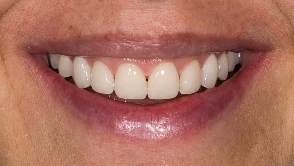 Veneers Before & After Image