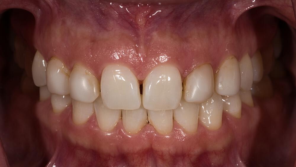 Veneers Before & After Image