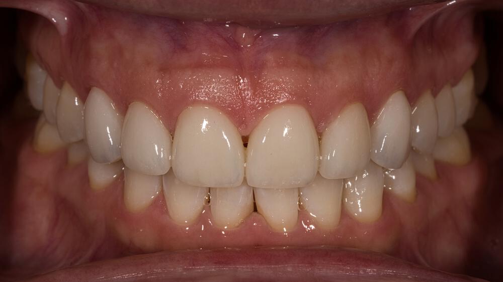 Veneers Before & After Image