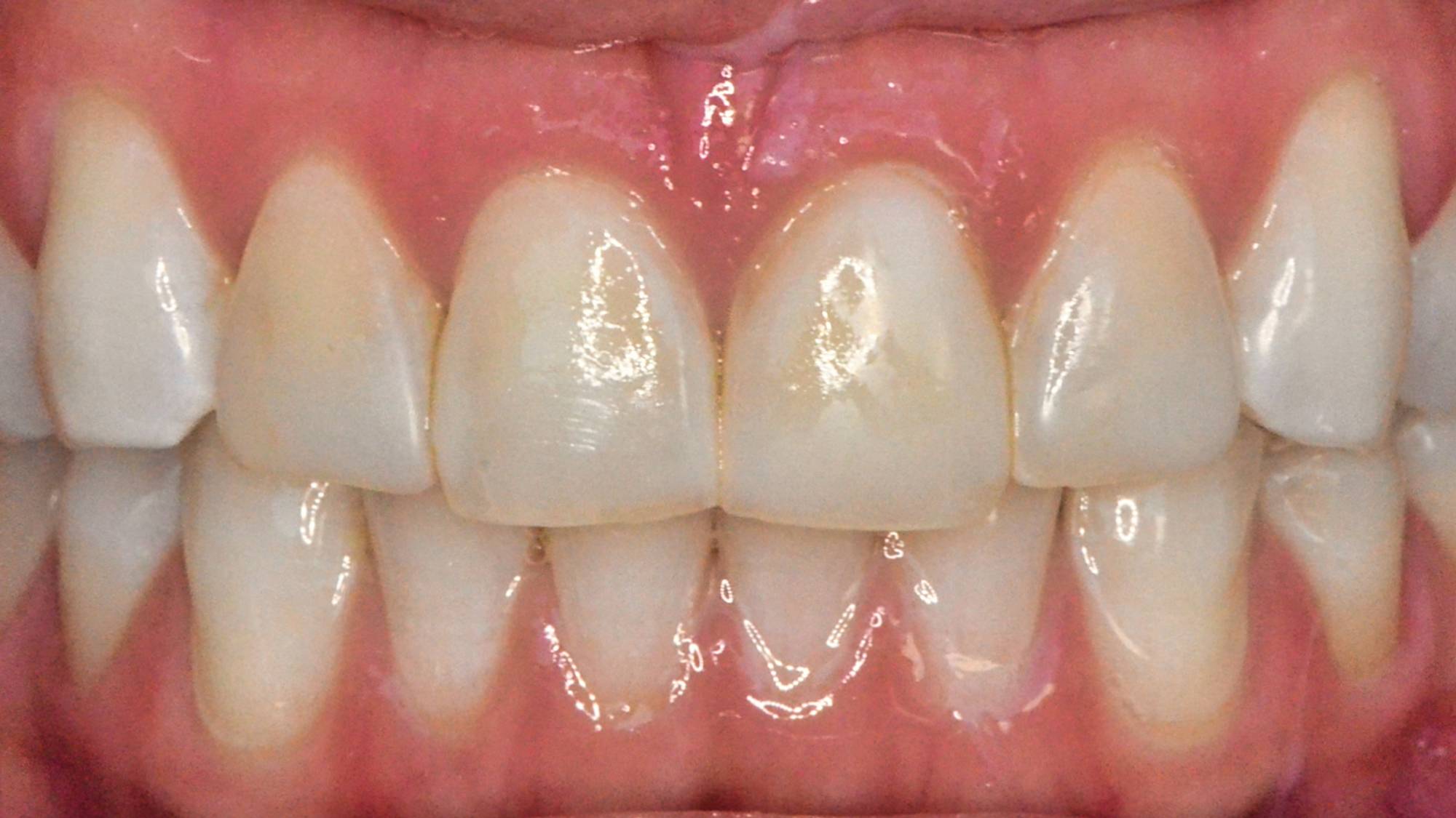 Veneers Before & After Image