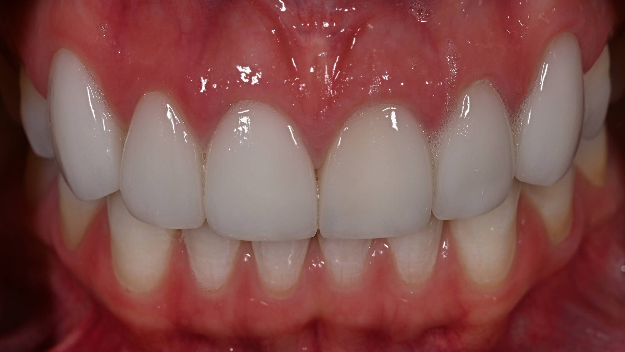 Veneers Before & After Image