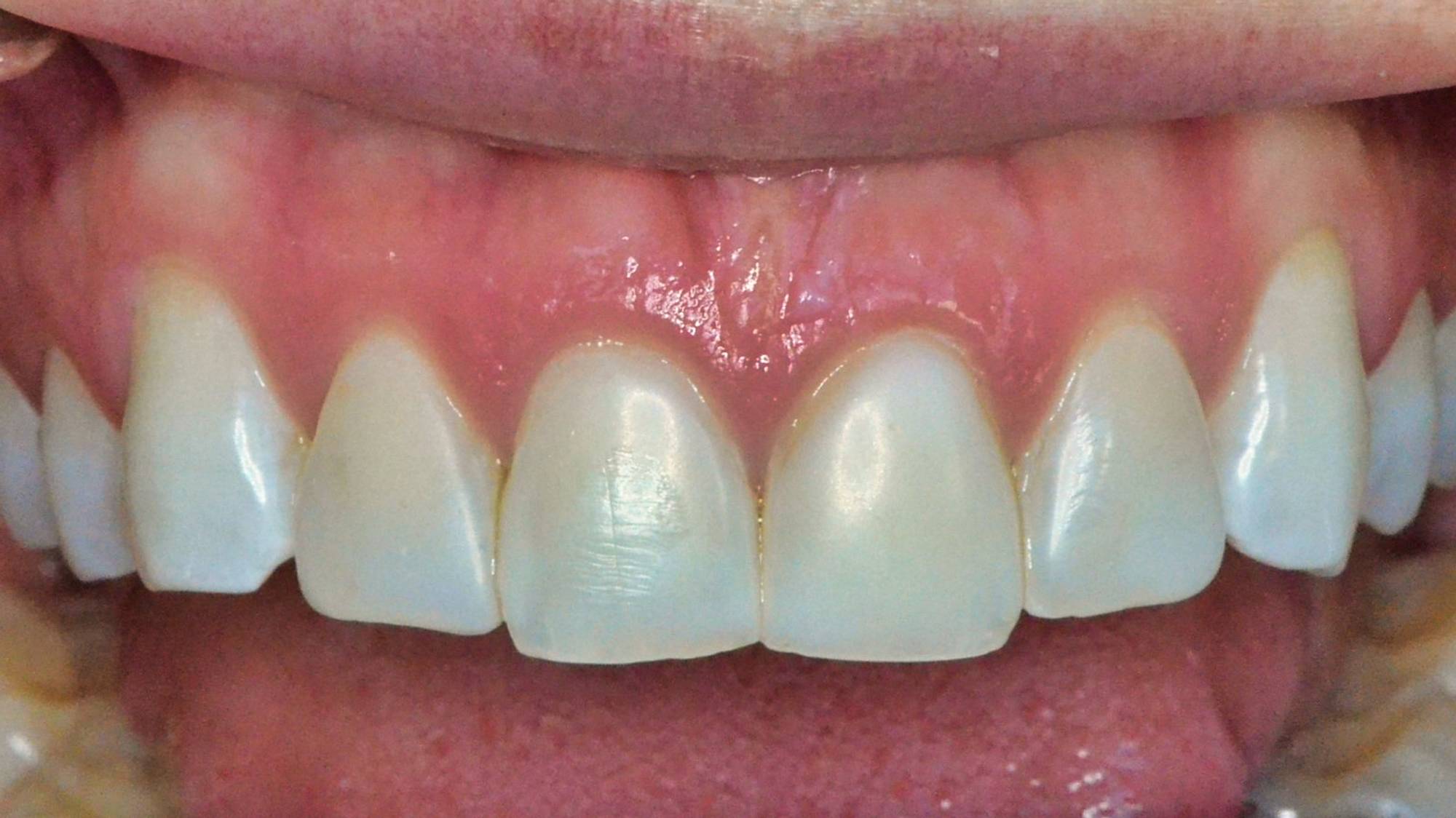 Veneers Before & After Image