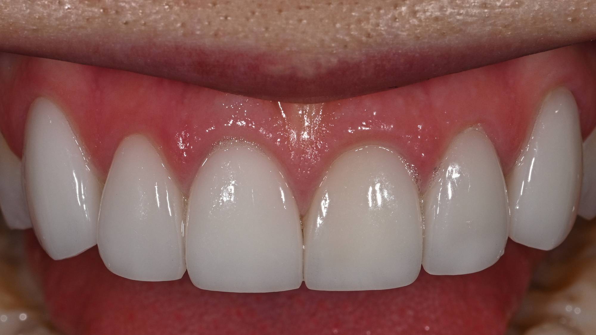 Veneers Before & After Image