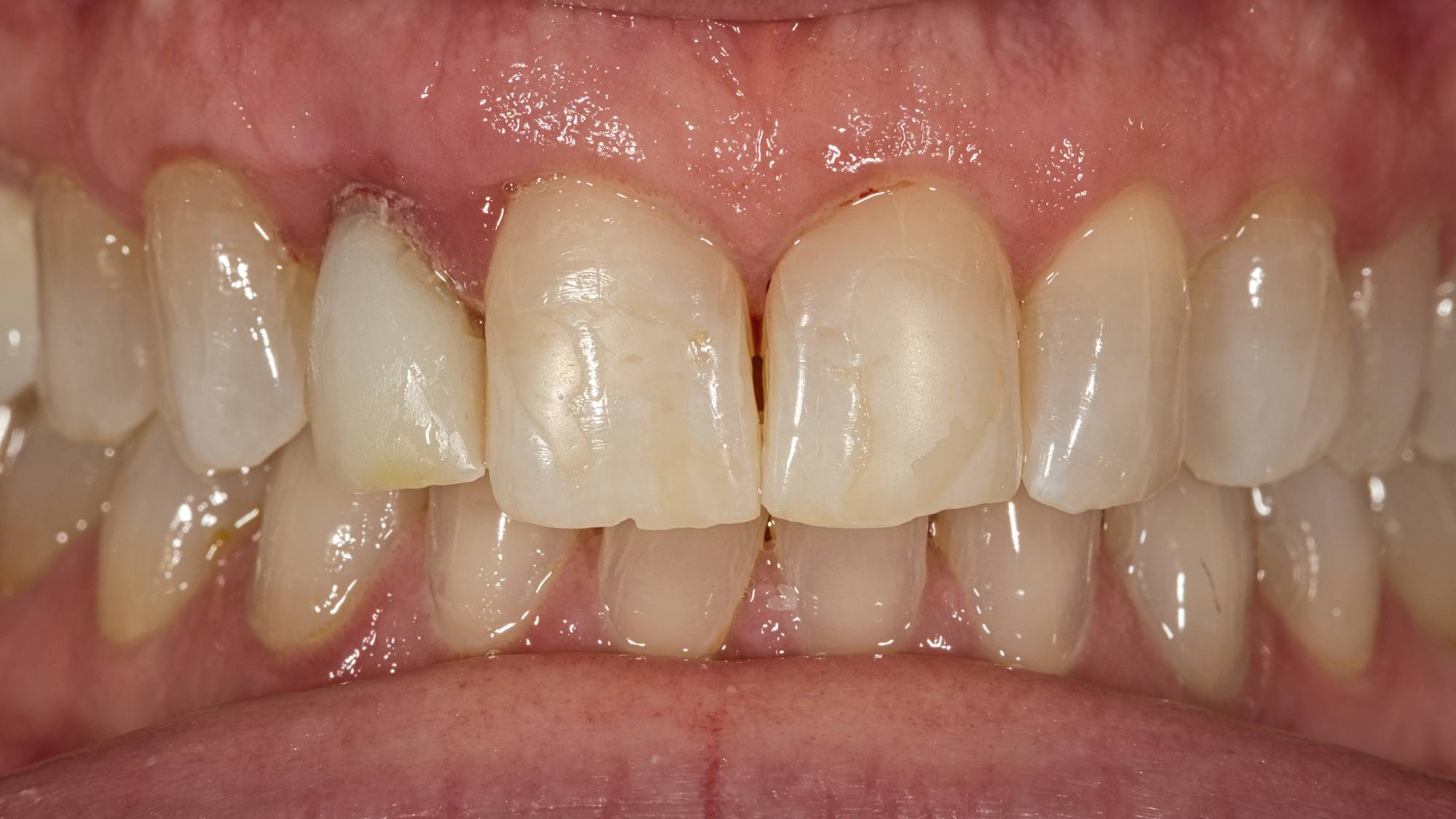 Veneers Before & After Image