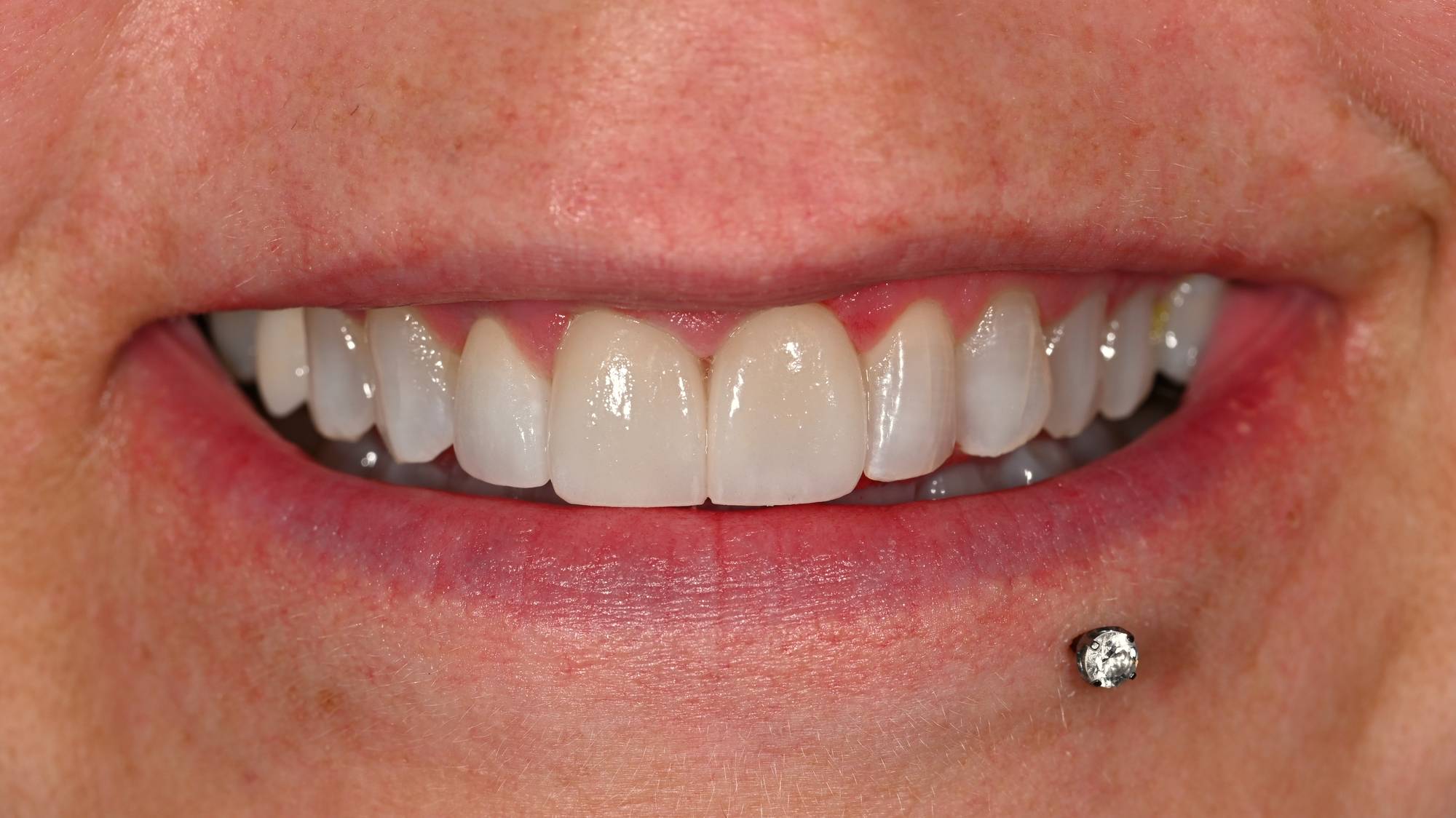 Veneers Before & After Image